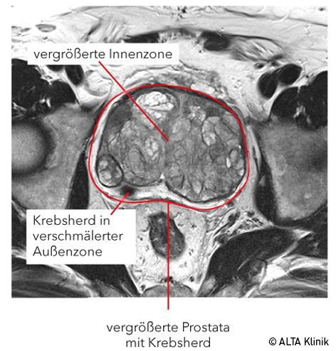 psa wert was sagt er aus ab wann prostatakrebs mit psa tabelle